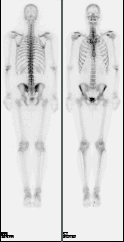 Scintigraphie osseuse au technétium 99m montrant le squelette entier